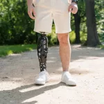Life after Amputation